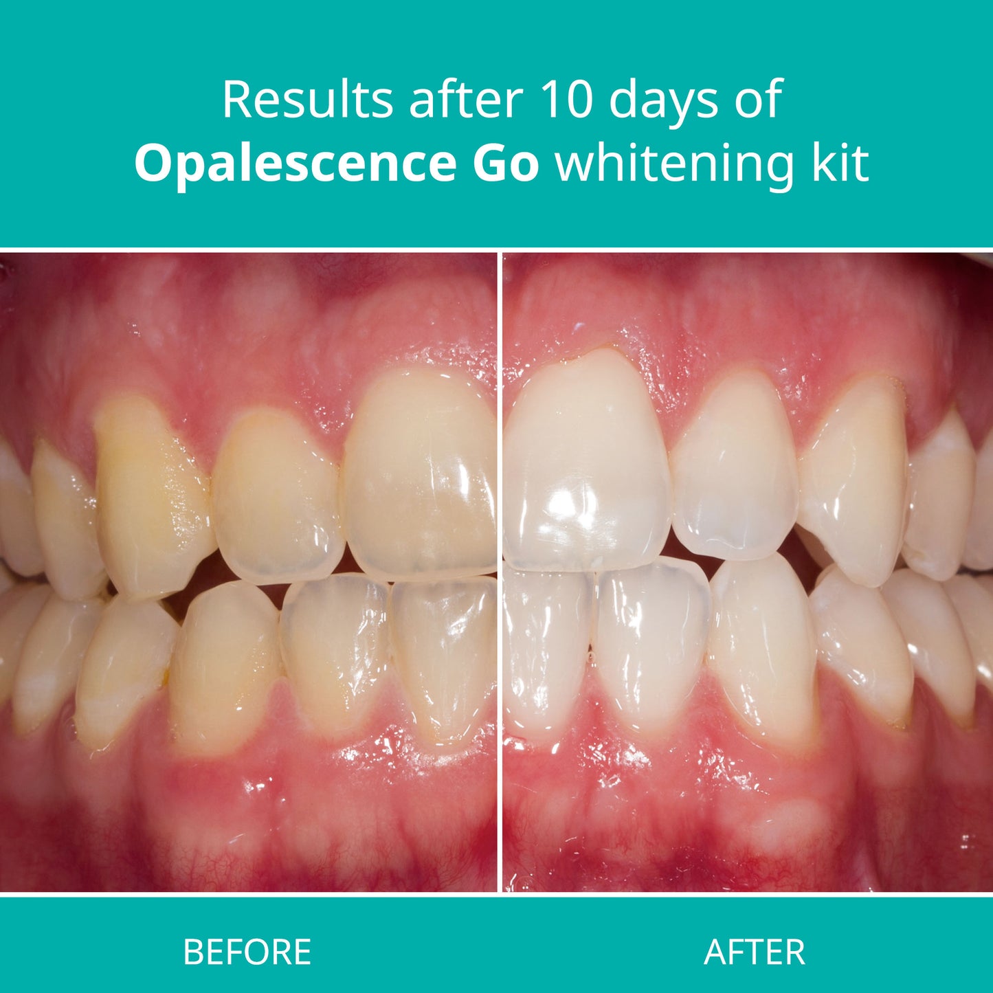 Opalescence Go - Prefilled Teeth Whitening Trays - 15% Hydrogen Peroxide - Mint
