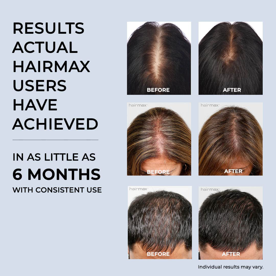 Hairmax Hair Growth Laser Band (FDA Cleared), LaserBand 41, Hair Growth for Men and Hair Regrowth Treatment for Women, Hair Laser Growth, Hair Growth Products, (100% Medical Grade Lasers, Not LEDs)